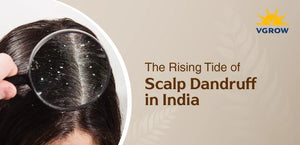 The Rising Tide of Scalp Dandruff in India