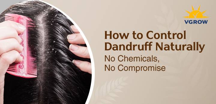 How to Control Dandruff Naturally — No Chemicals, No Compromise
