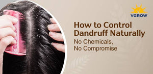 How to Control Dandruff Naturally — No Chemicals, No Compromise