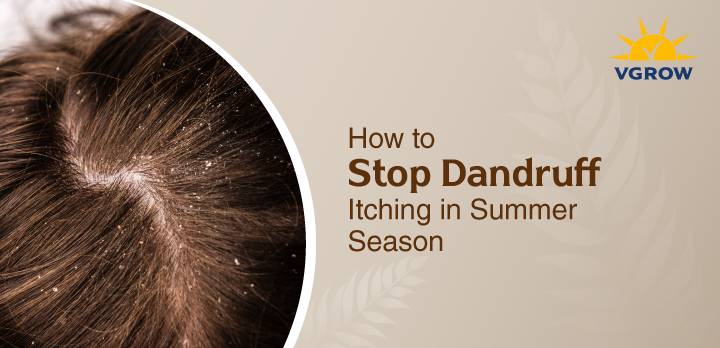 How to Stop Dandruff Itching in the Summer Season