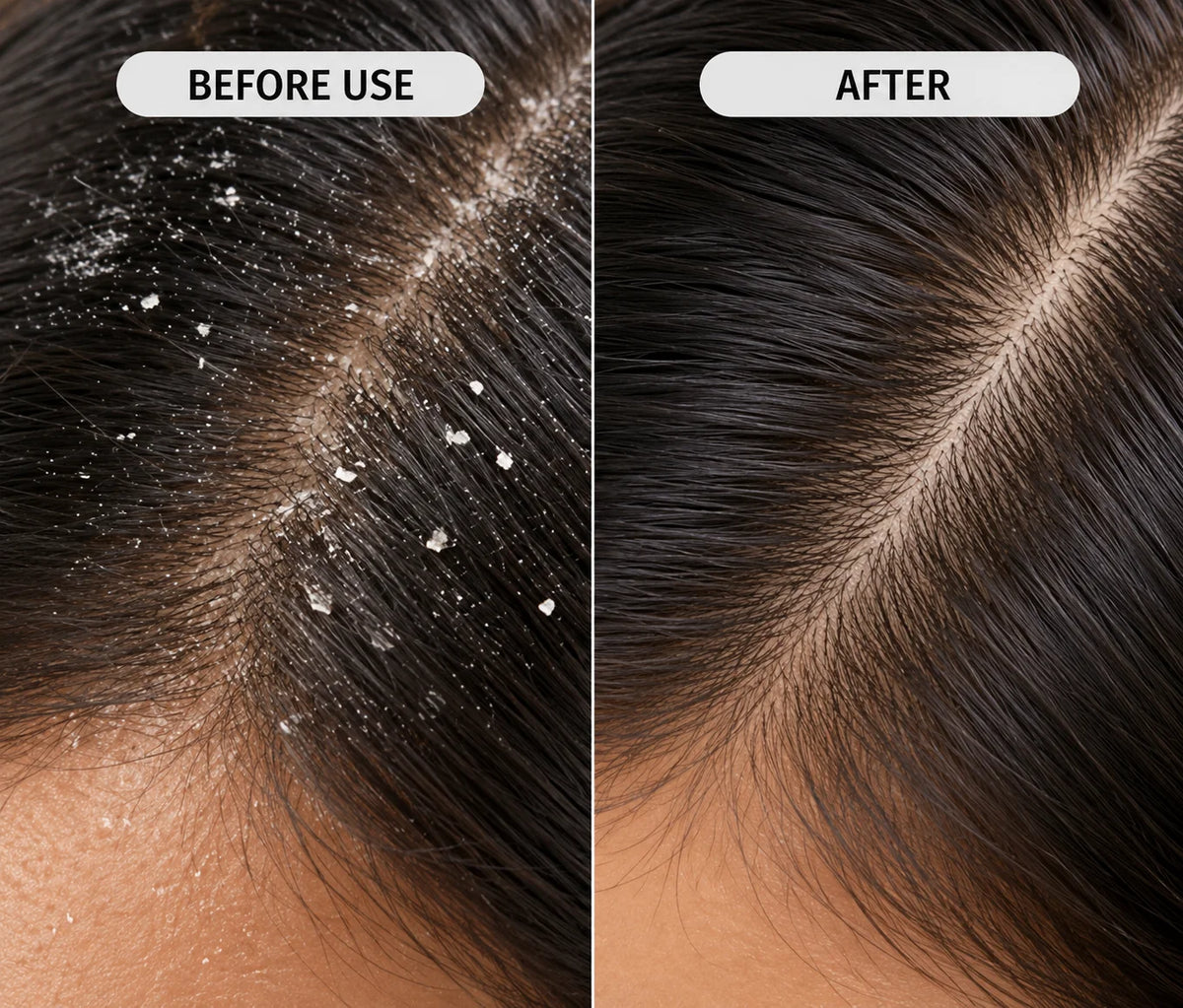 Ayurvedic Anti Dandruff Hair Oil