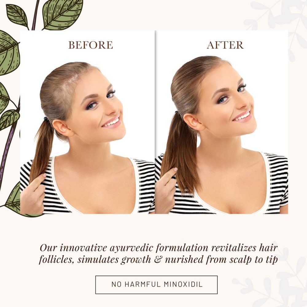Witness a visible transformation in hair density and strength. We invite you to accept the 21-Day VGROW Challenge. Use the oil as directed, and if your hair doesn't show signs of new growth, our money-back guarantee has you covered. You have nothing to lose but hair fall.